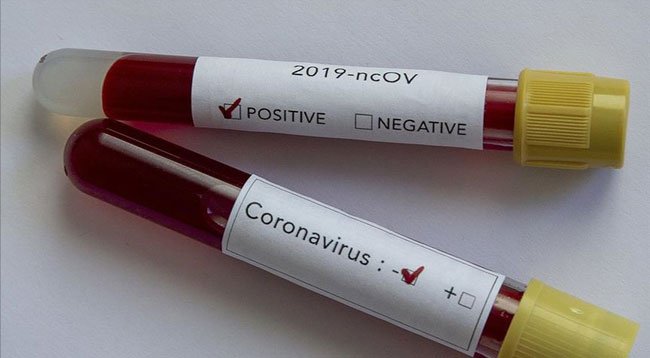 Koronavirüs Sindirim Yoluyla Bulaşmıyor